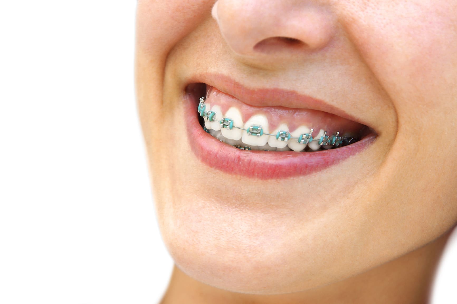 9 Foods You Can Eat With Braces